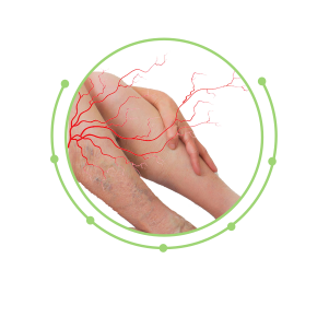 varicose vein copy.png